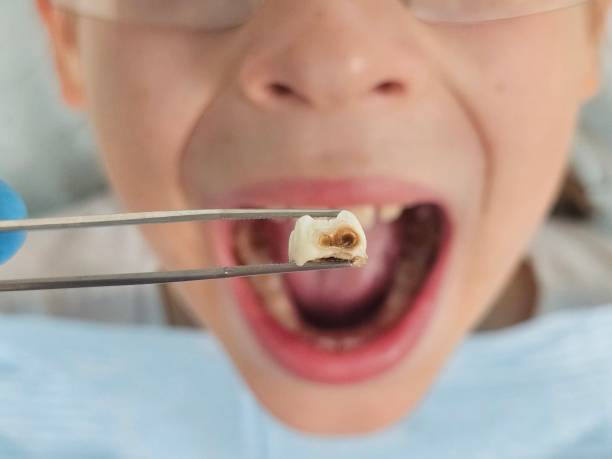 Best Emergency Treatment for Toothache in Overland Park, KS